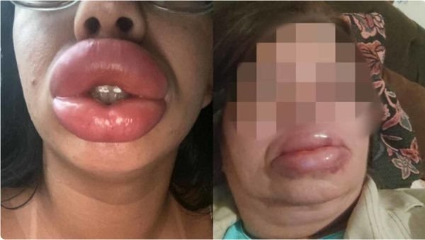 Preços promocionais e lábios deformados: como agia falsa biomédica