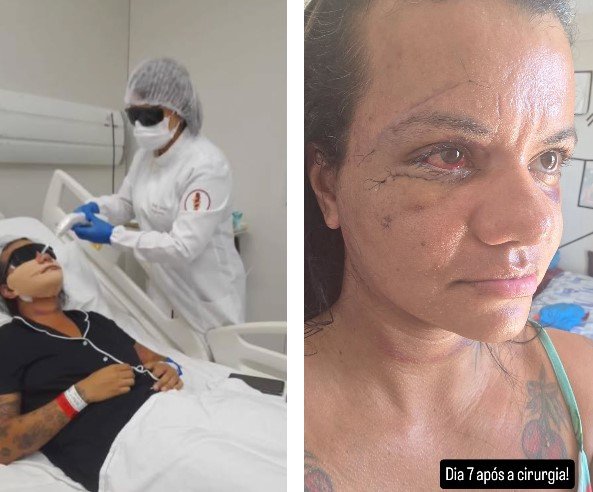 Juliana Soares, agredida com 61 socos em elevador em Natal, mostra recuperação sete dias após cirurgia de reconstrução facial